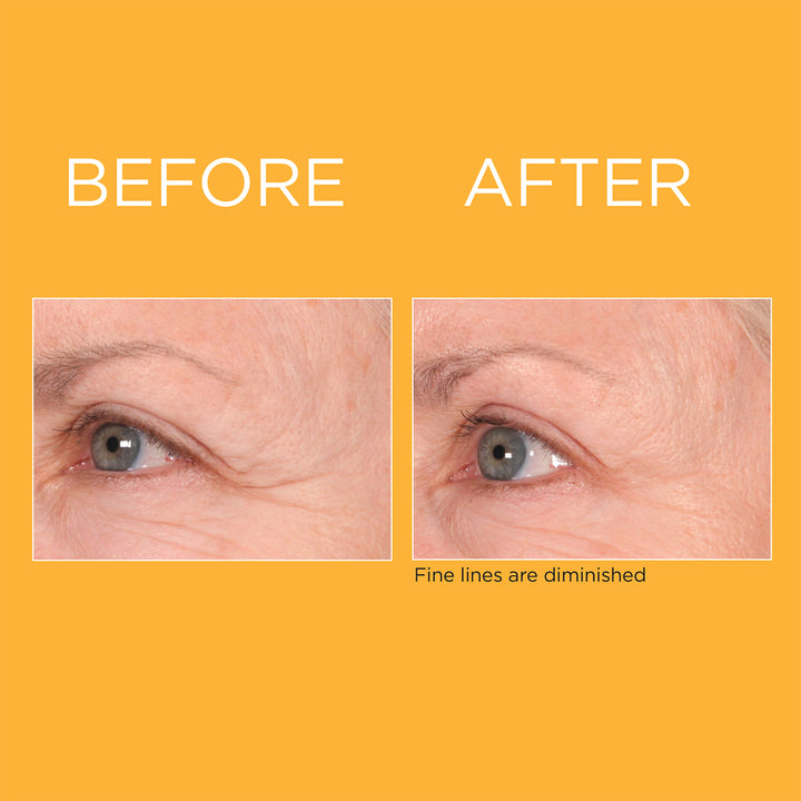 PREVAGE® Progressive Renewal Treatment Before vs. After